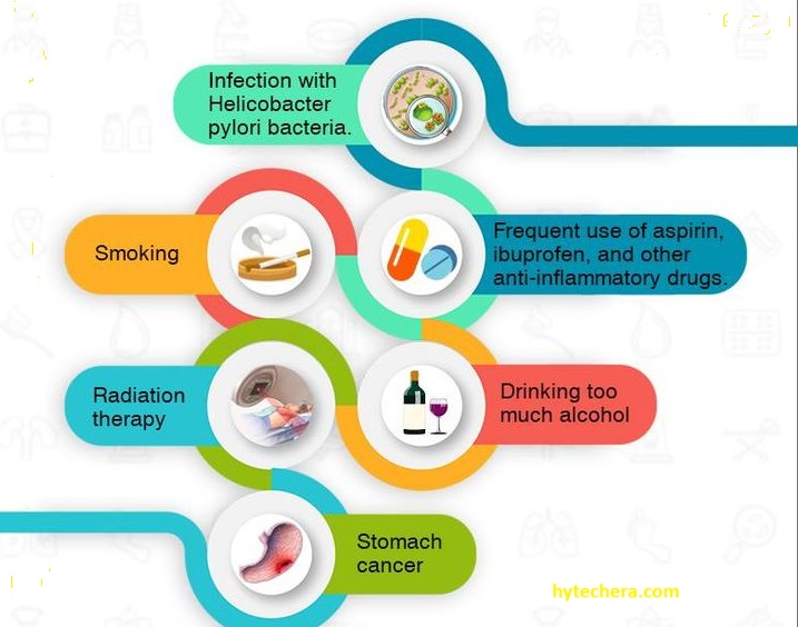 Causes of peptic ulcer Visual showing risk factors for peptic ulcers: smoking, alcohol, and stress