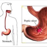 Illustration showing the location of a peptic ulcer in the stomach lining